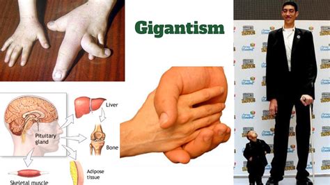 The spell of gigantism